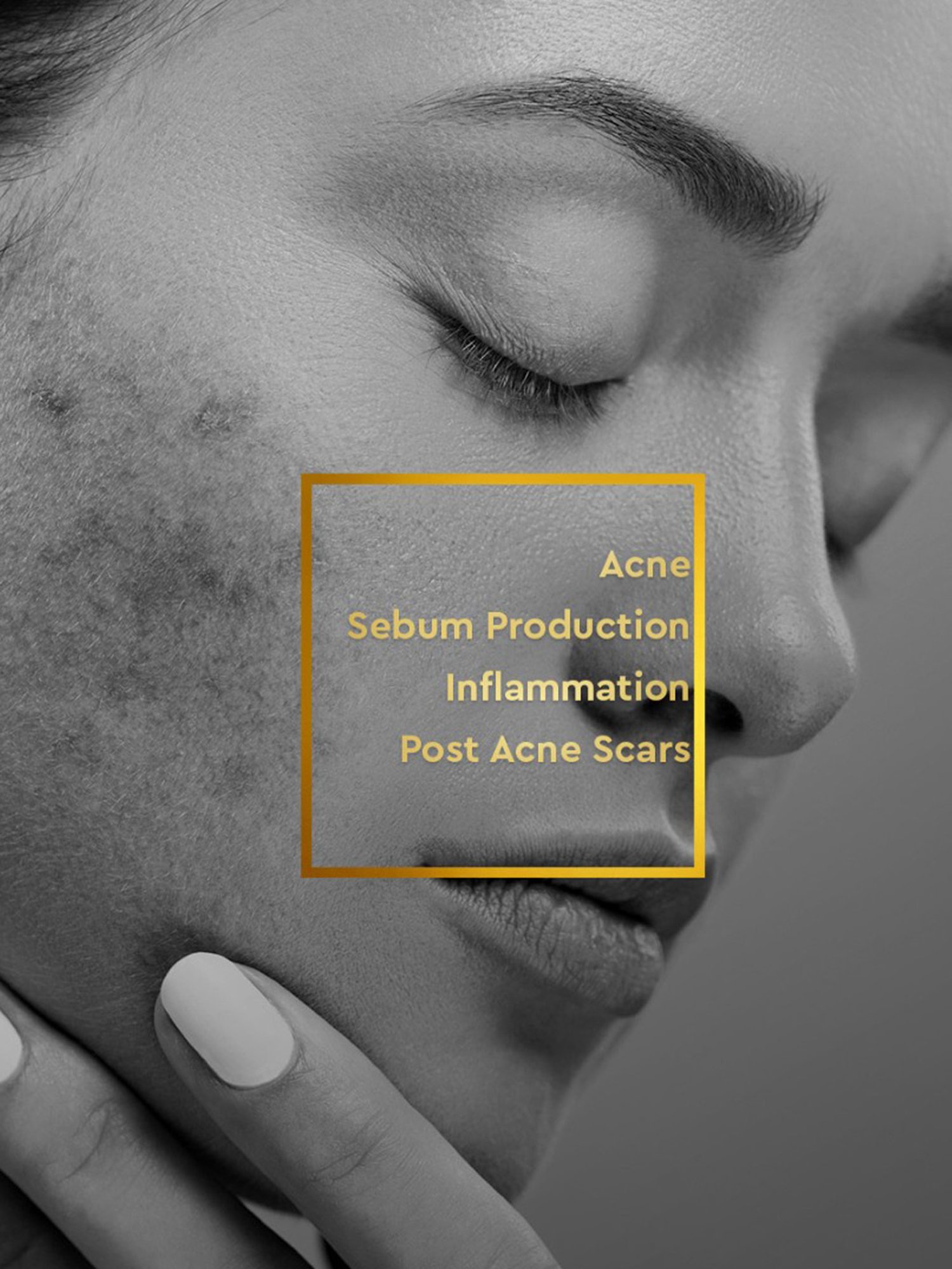 VLCC Clinic Anti Acne Face Wash, ProRescue Micro Serum & Bio Cream Combo