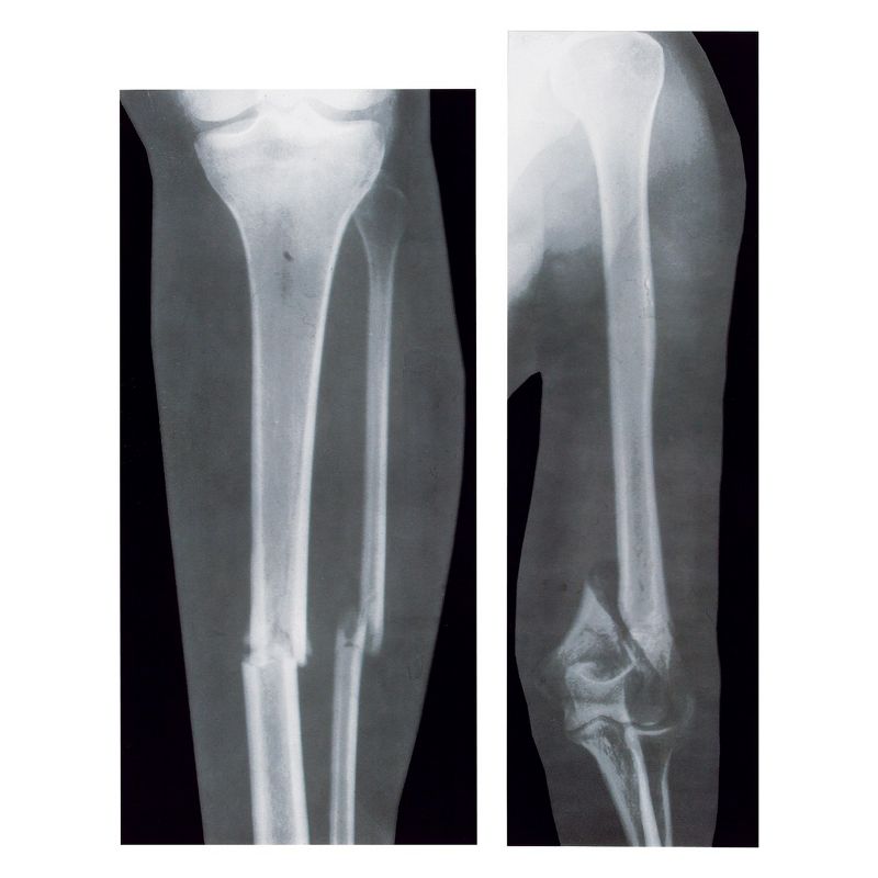Roylco Broken Bones X-Rays