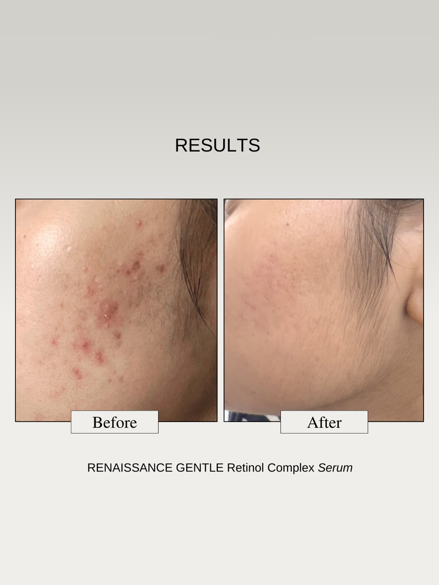 The Formularx Renaissance Gentle Retinol Complex Serum - 30 gm