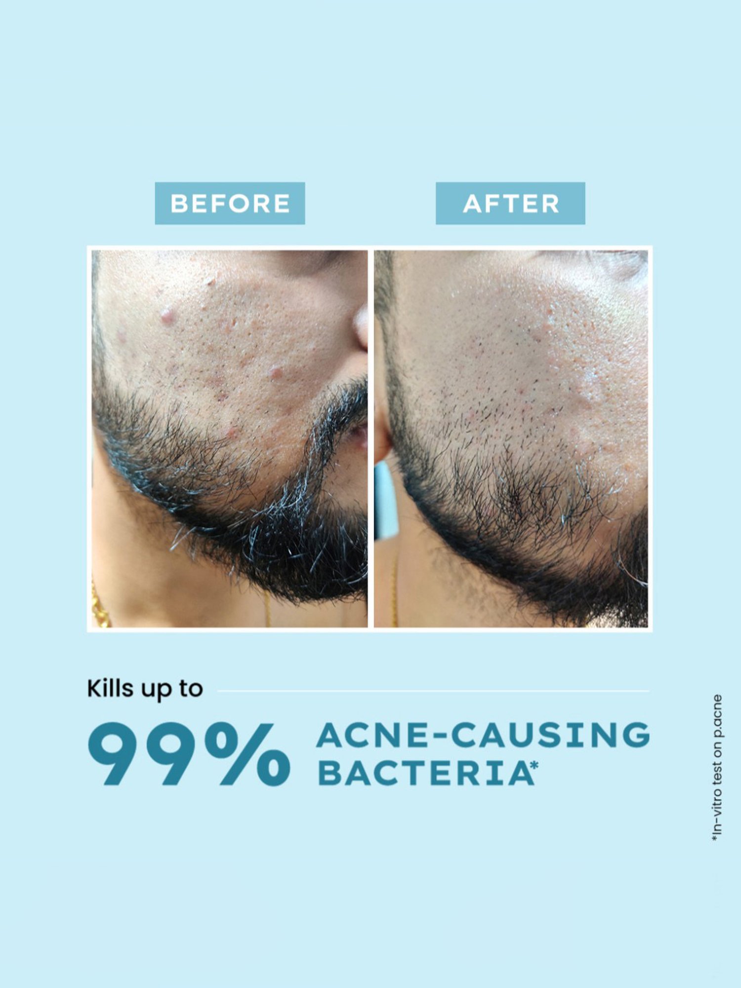 Hyphen Acne Defence Daily Serum - 30 ml