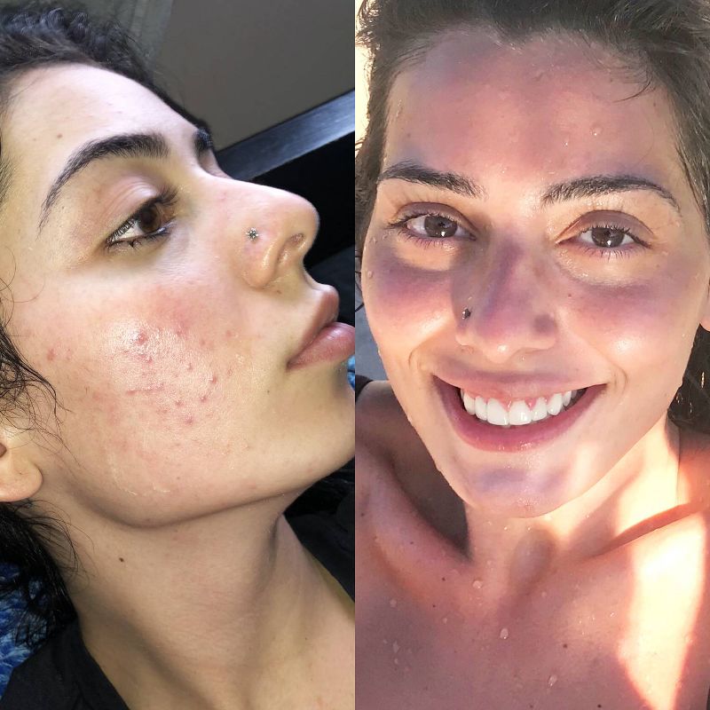 NxN Acne Edit System - 4ct