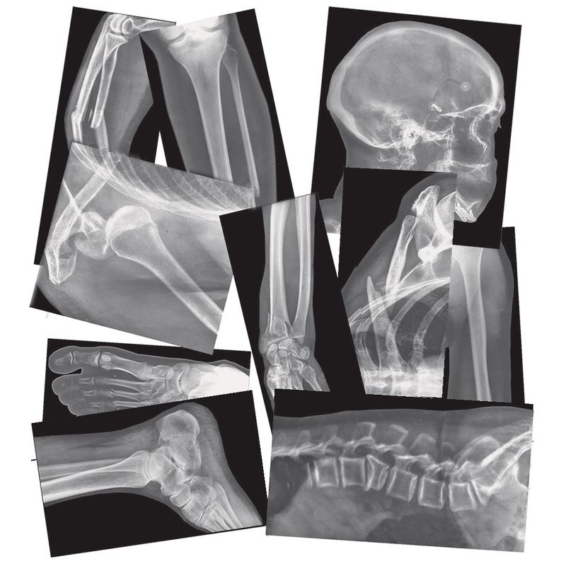 Roylco Broken Bones X-Rays