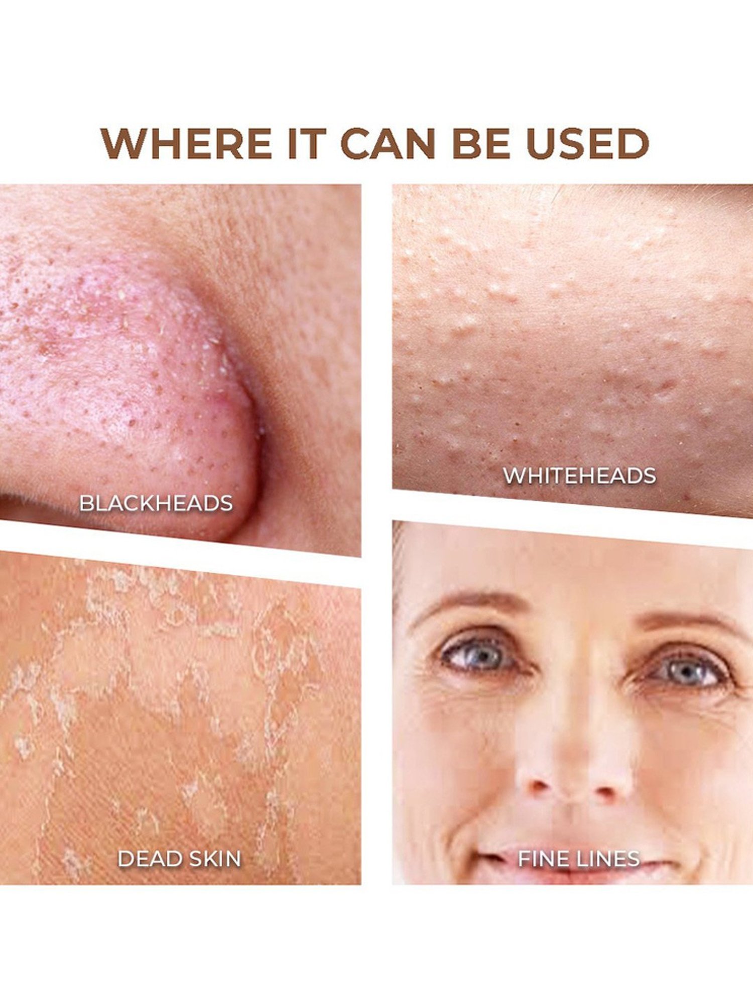 WINSTON Vacuum Blackhead Remover & Pore Cleaner with 3 Suction Modes & 5 Replaceable Heads