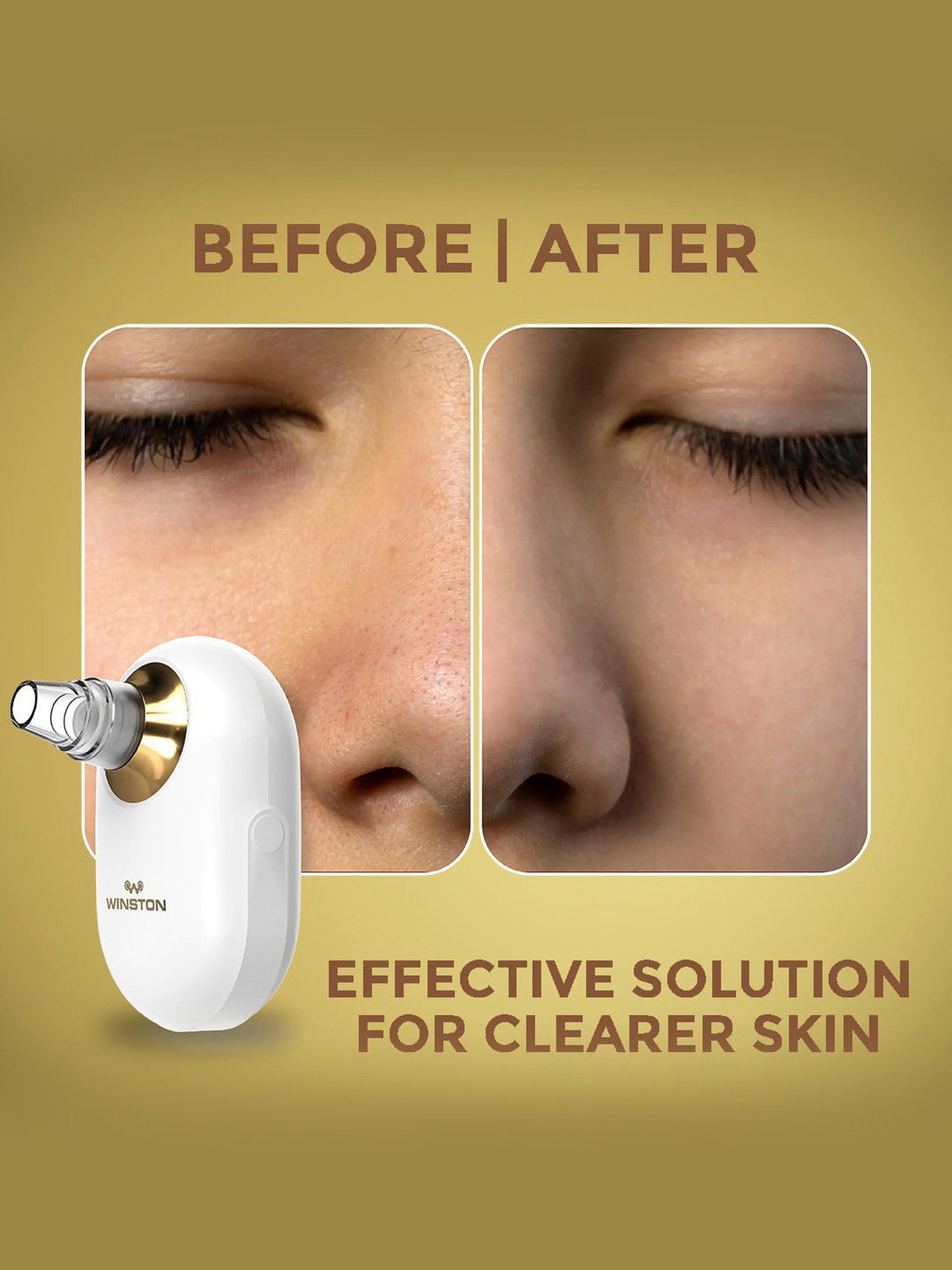 WINSTON Vacuum Blackhead Remover & Pore Cleaner with 3 Suction Modes & 5 Replaceable Heads