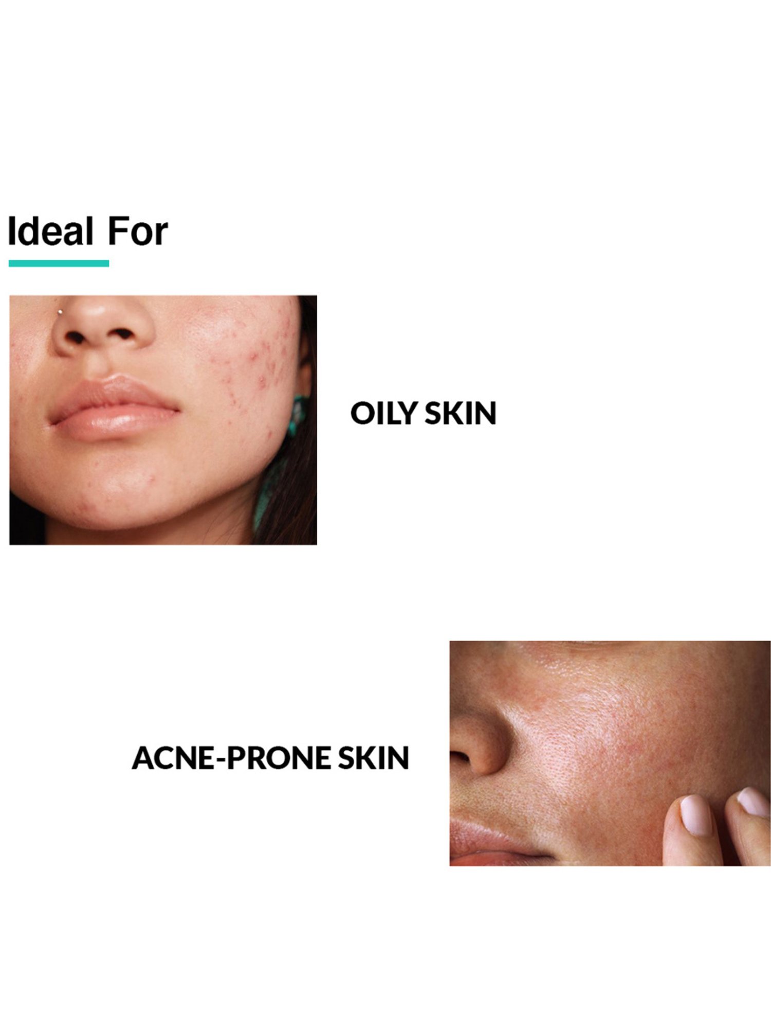 Fixderma Anti-Acne Face Serum for Men & Women - 30 gm