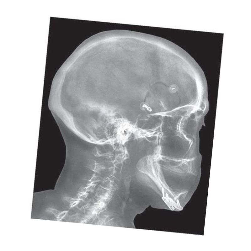 Roylco Broken Bones X-Rays
