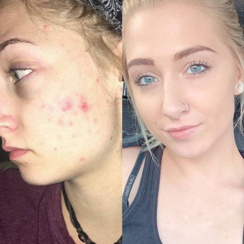 NxN Acne Edit System - 4ct