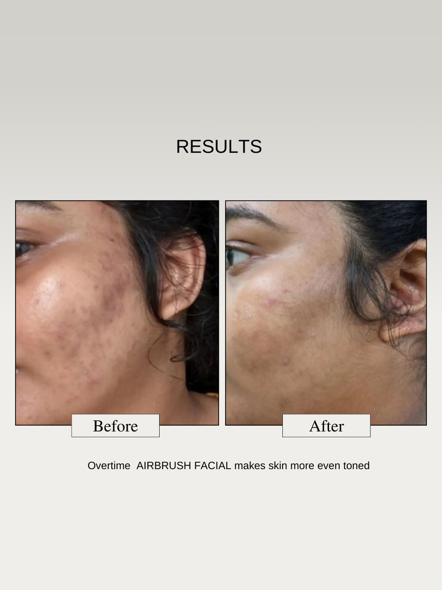 The Formularx Air Brush Facial Lactic Acid Serum - 50 gm