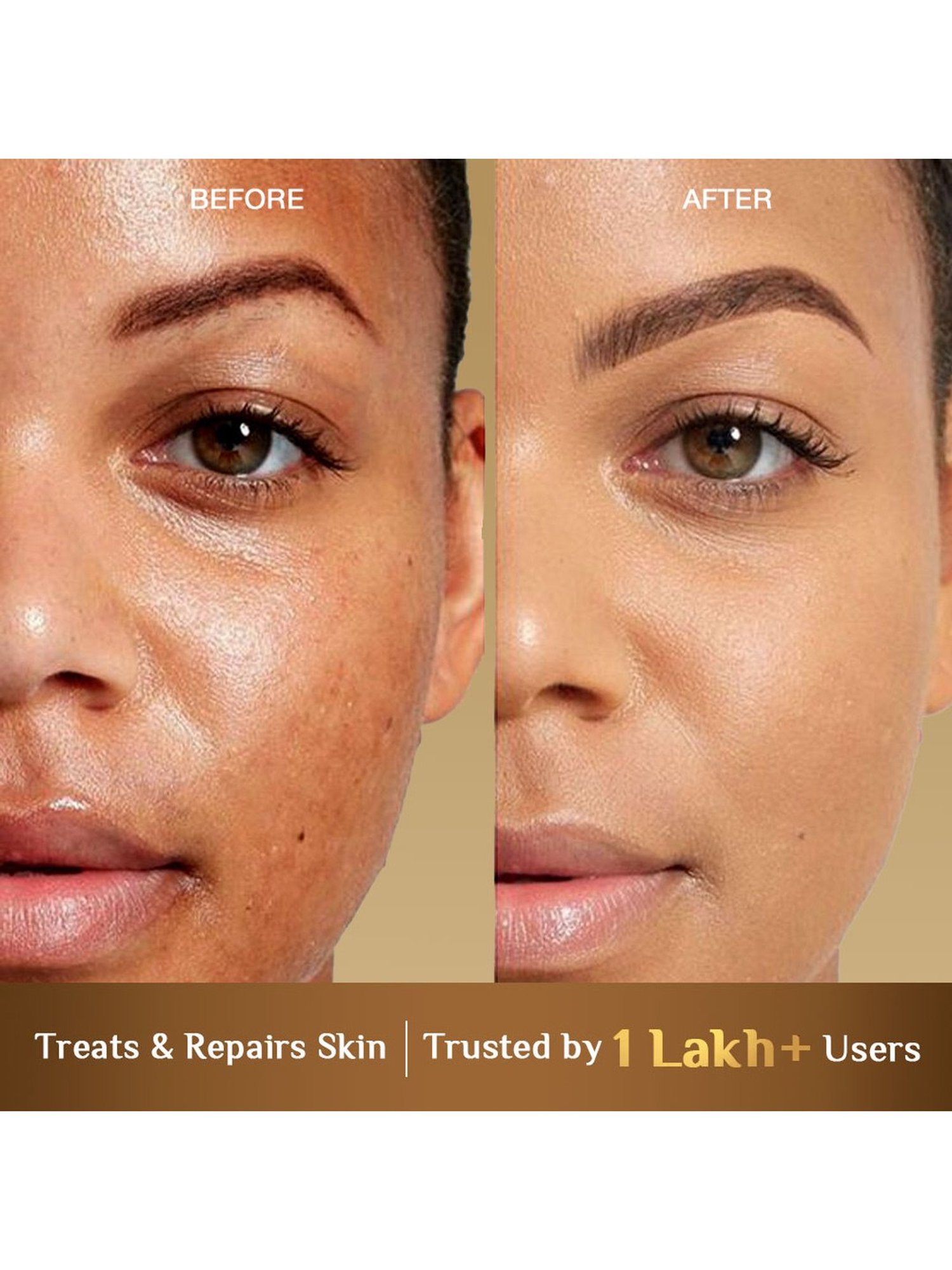 Richfeel Calendula Anti Acne Soap - Pack of 6