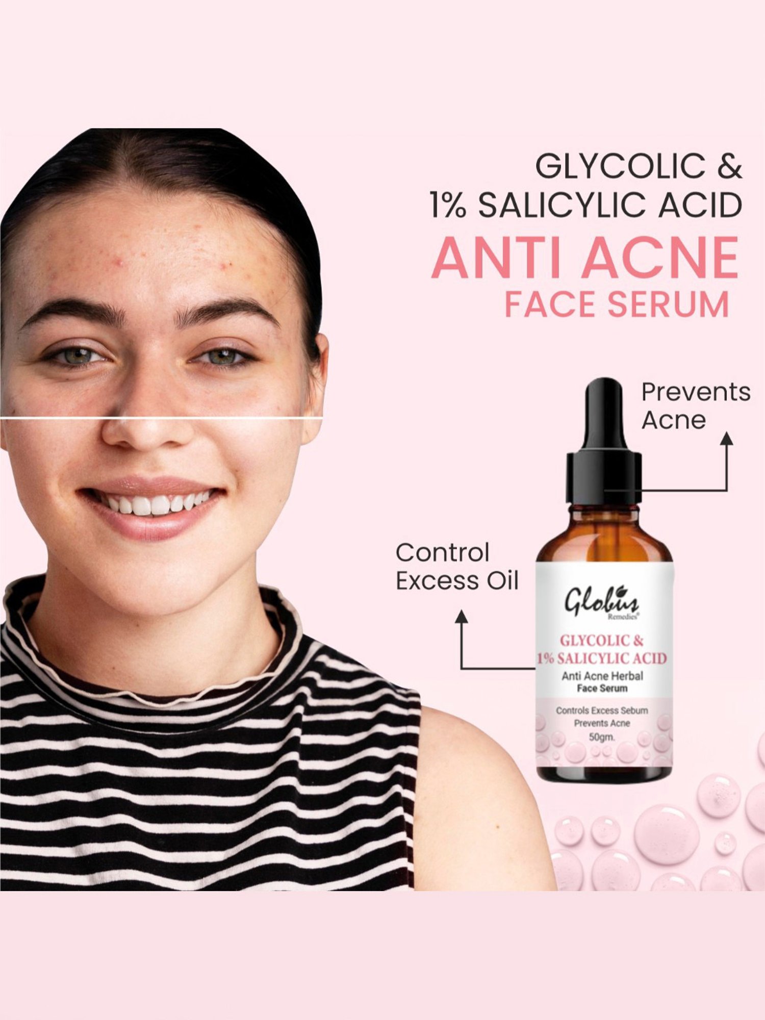 Globus Remedies Glycolic & 1% Salicylic Acid Anti Acne Herbal Face Serum - Pack of 5