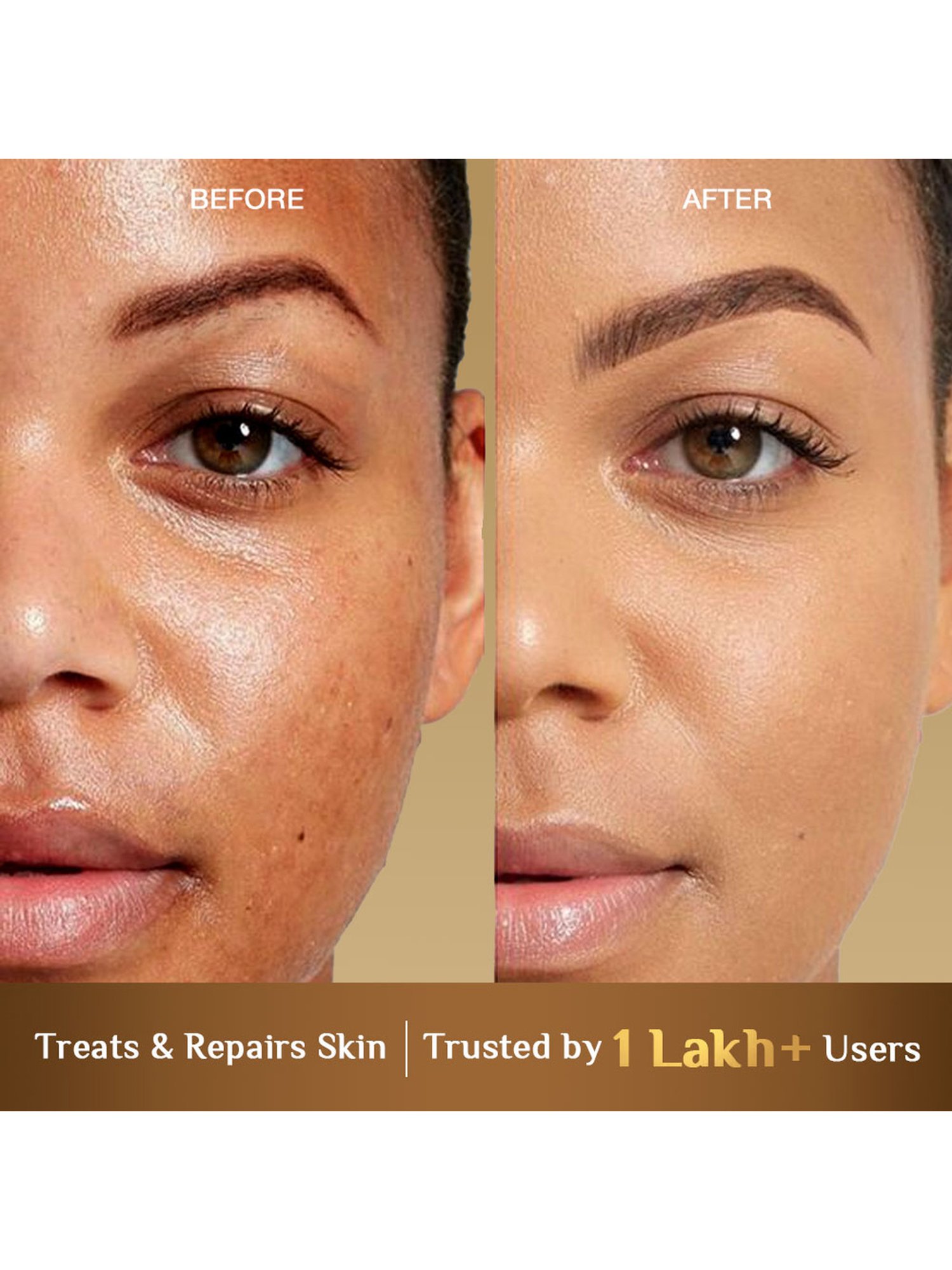 Richfeel Calendula Anti Acne Soap - Pack of 5