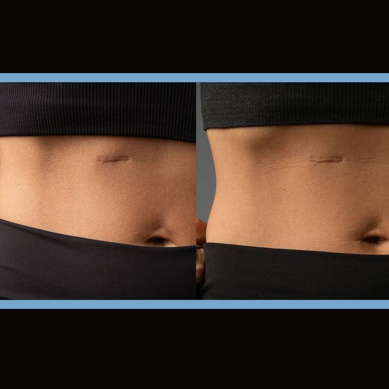 ScarAway Scar Treatment Gel - .35oz