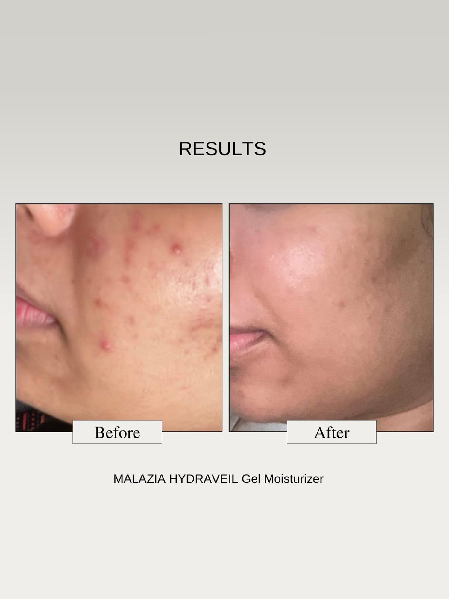 The Formularx Malazia Hydra Veil Gel Moisturizer - 50 gm