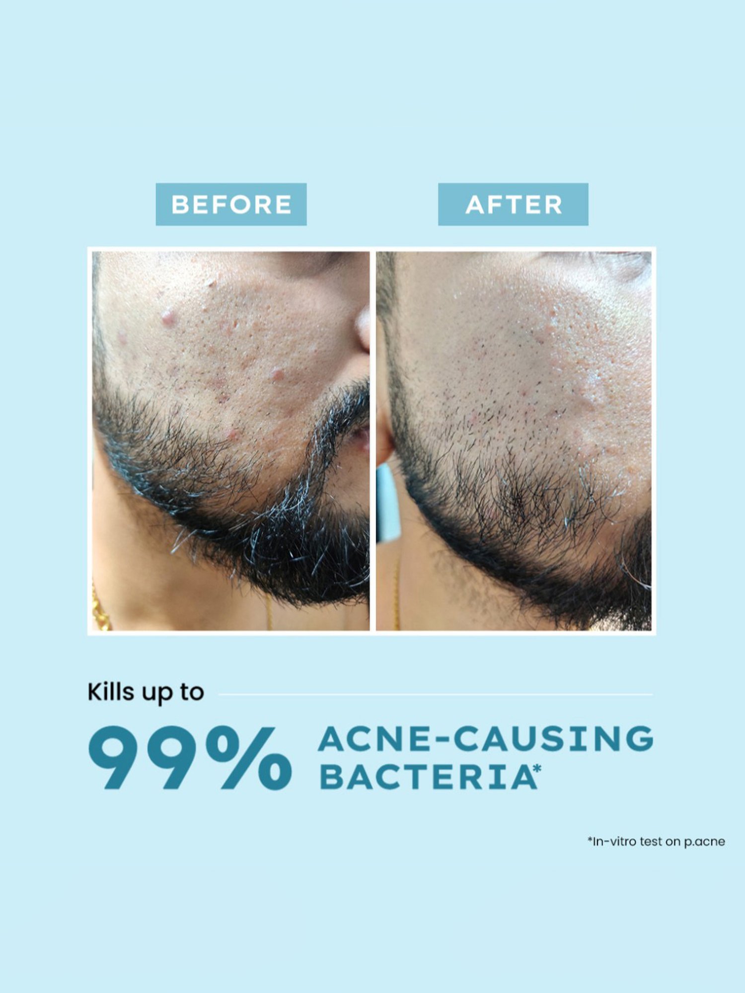 Gush Dart It Hydrocolloid Pimple Patches Combo - Mega Pack of 6