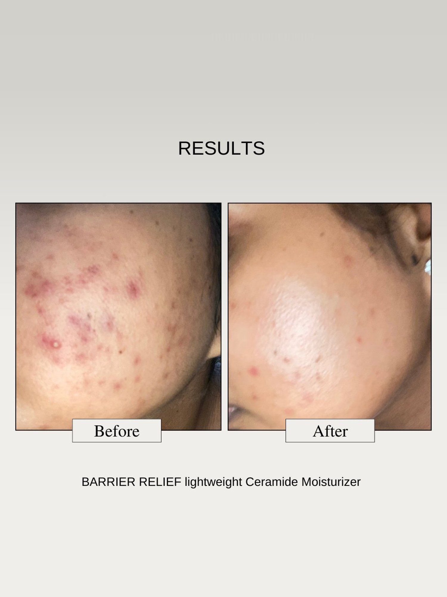 The Formularx Barrier Relief Lightweight Moisturizer - 50 gm