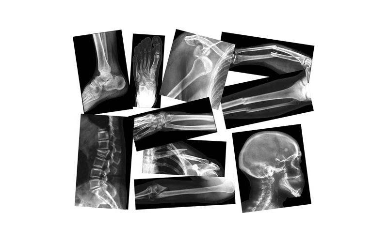 Roylco Broken Bones X-Rays