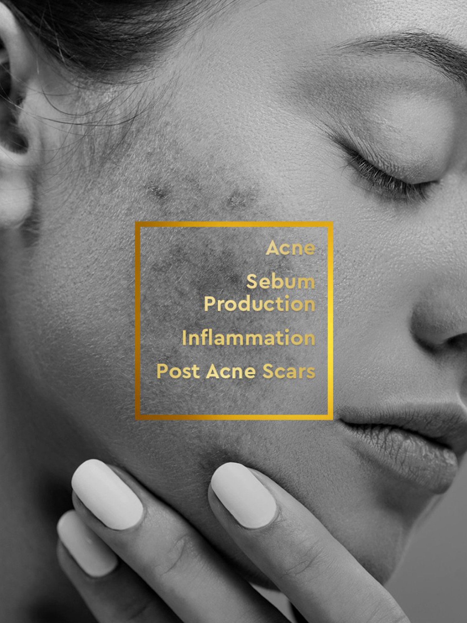 VLCC Clinic Anti Acne Face Wash, DeTan Sun Screen, ProRescue Micro Serum & Bio Cream Combo