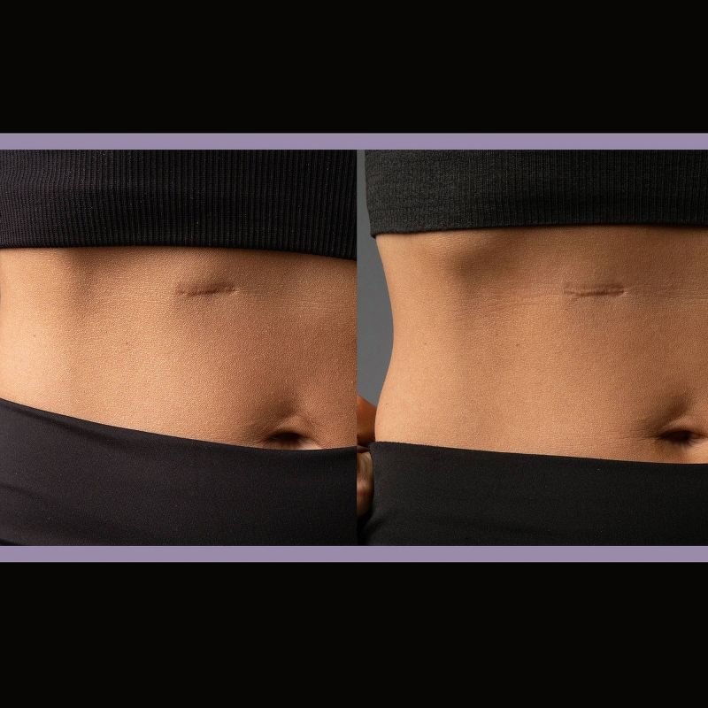 ScarAway Complete Scar Treatment Kit