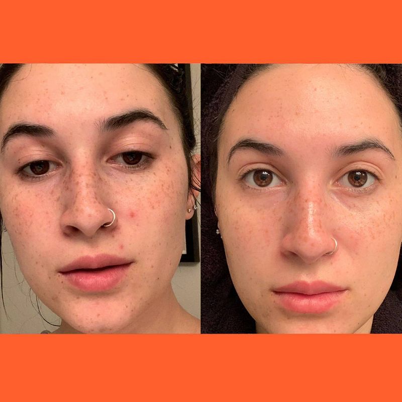 No B.S. Skincare Healing Acne Patches - 36ct