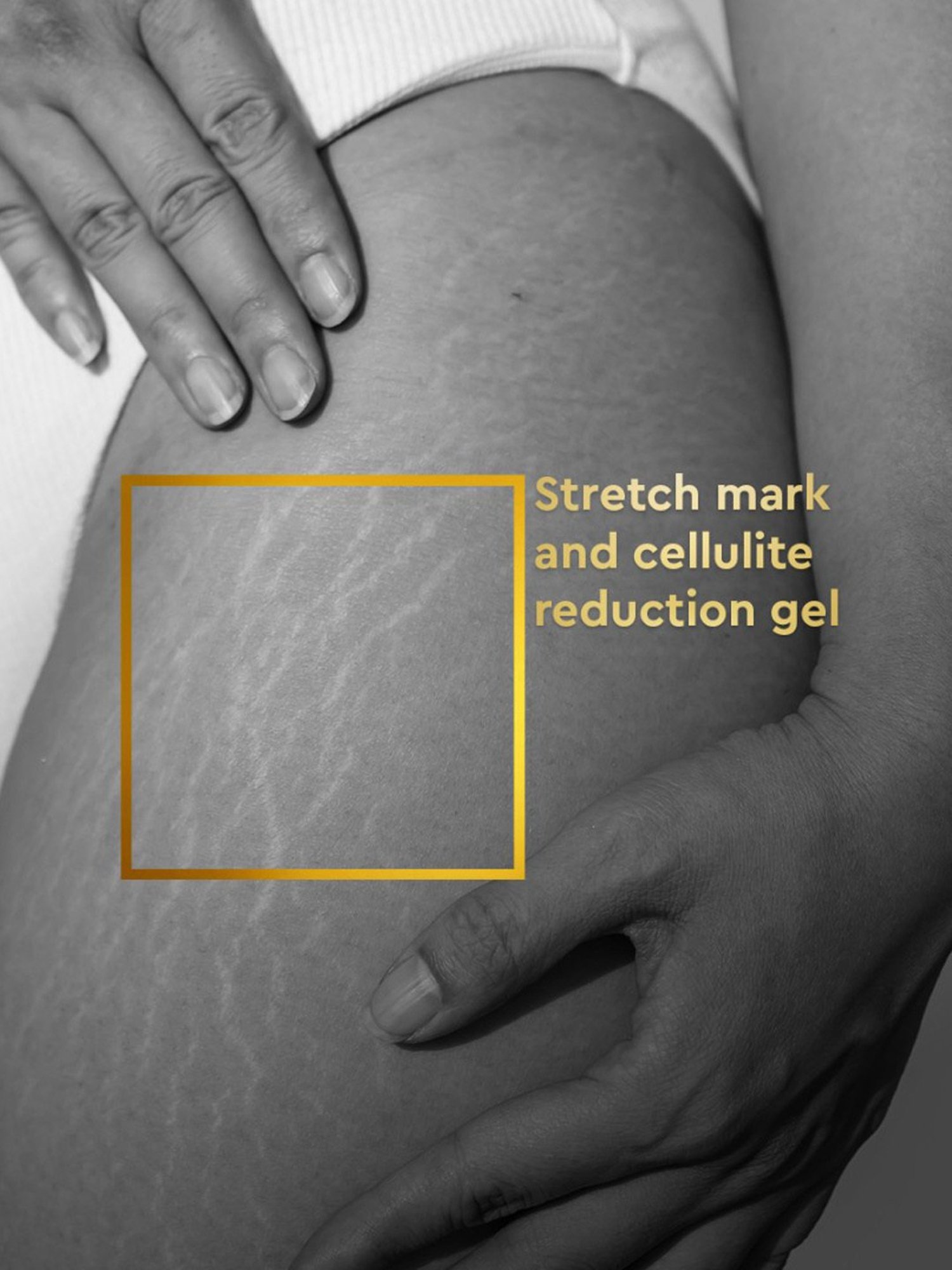 Mom & World Skin Bio Therapy Oil For Stretch Marks - 200 ml