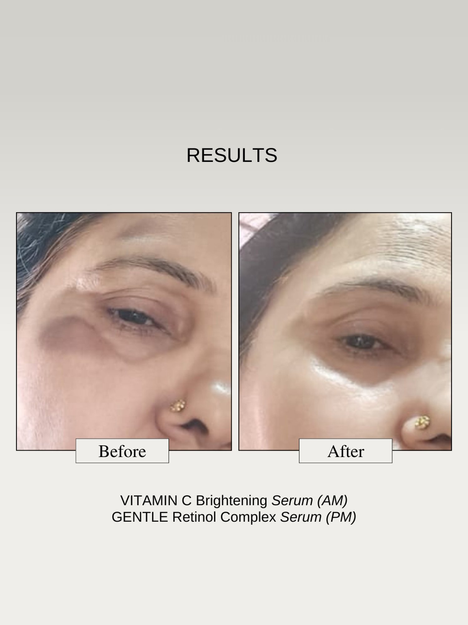The Formularx Vitamin C + Arbutin + N-acetylglucosamine 14% Brightening Complex Serum - 30 gm