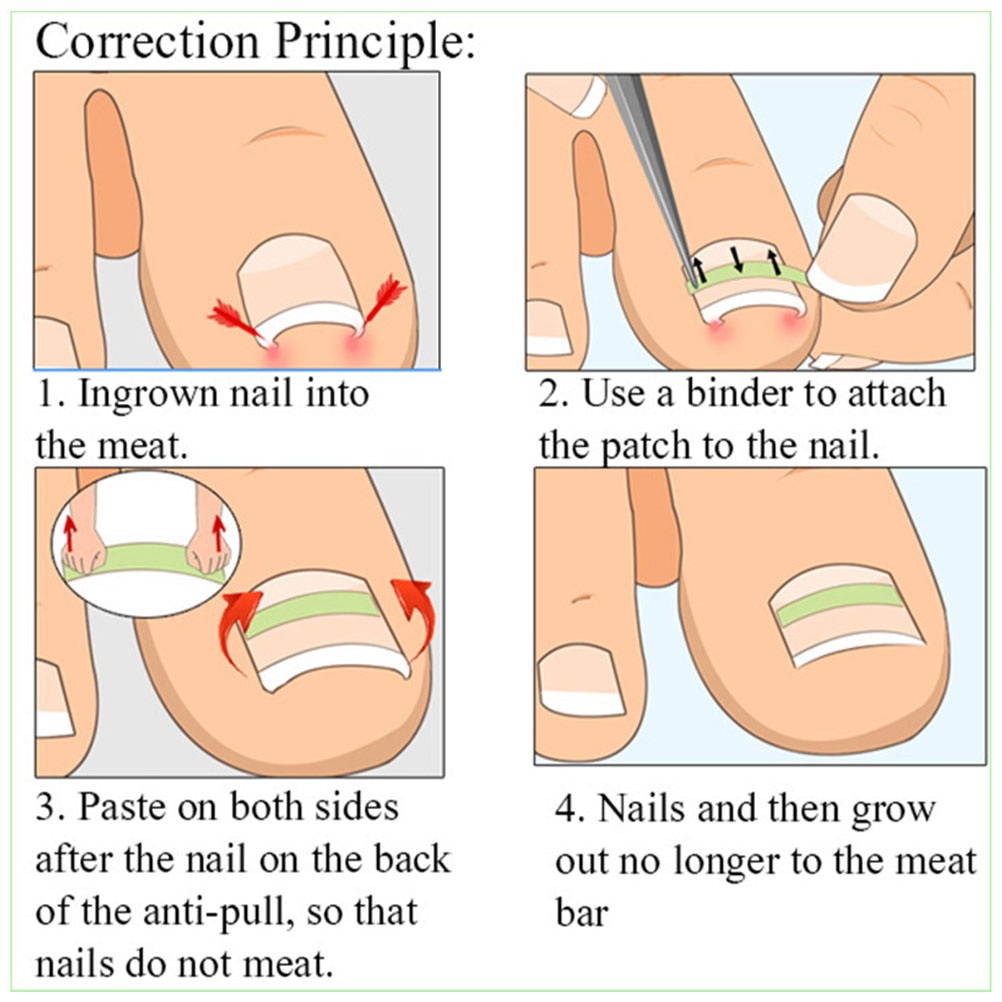 1 Set Ingrown Toenail Correction Strips Brace Toenails Thick Correction Tool